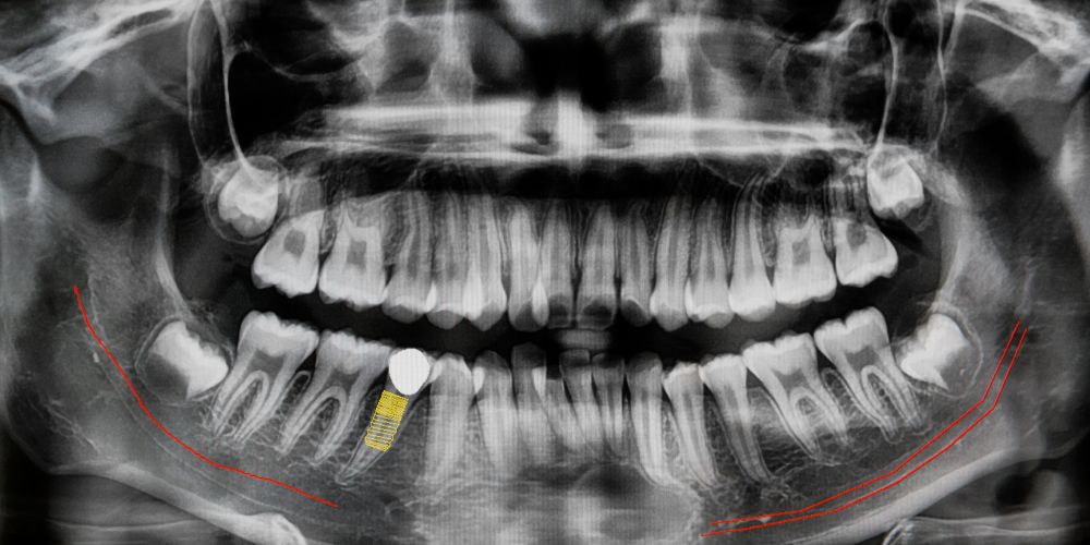 Cirug A Guiada La Mejor T Cnica Para La Colocaci N De Implantes